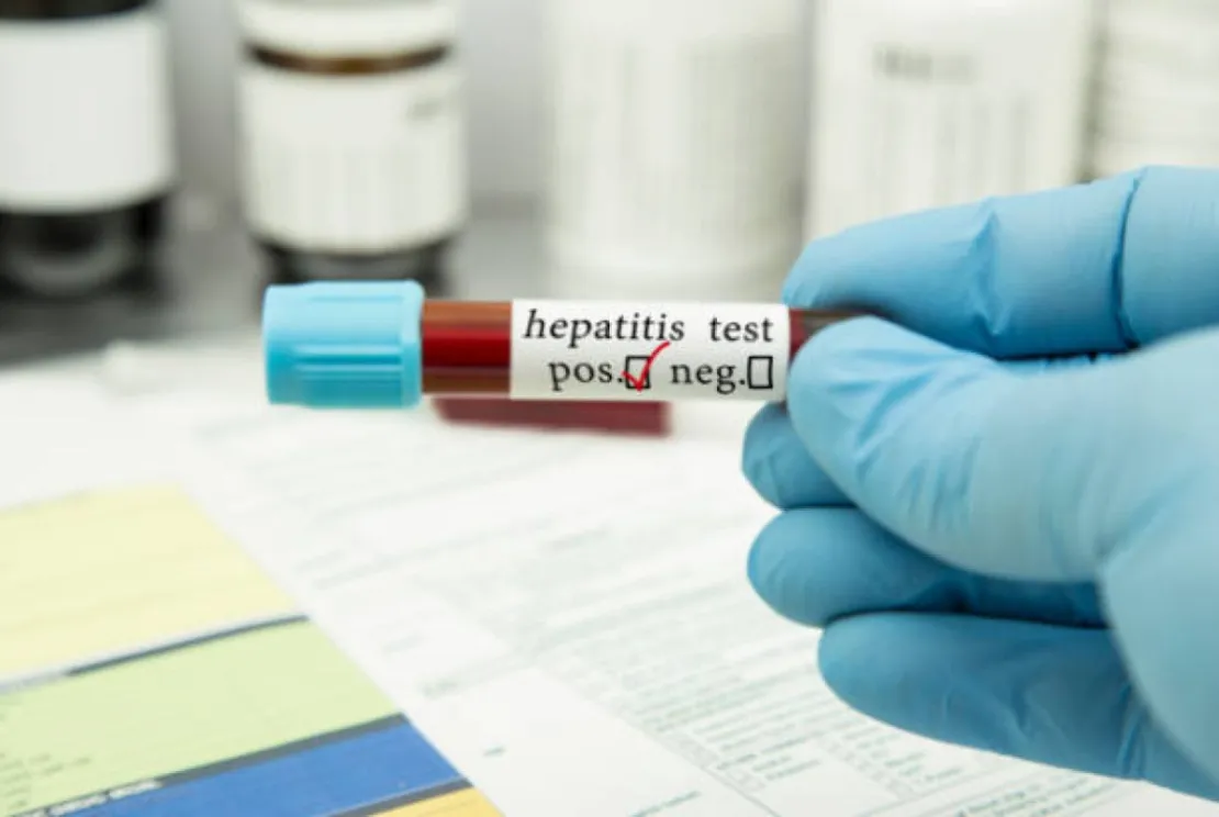5 Fakta Hepatitis Misterius yang Menyerang Anak-anak