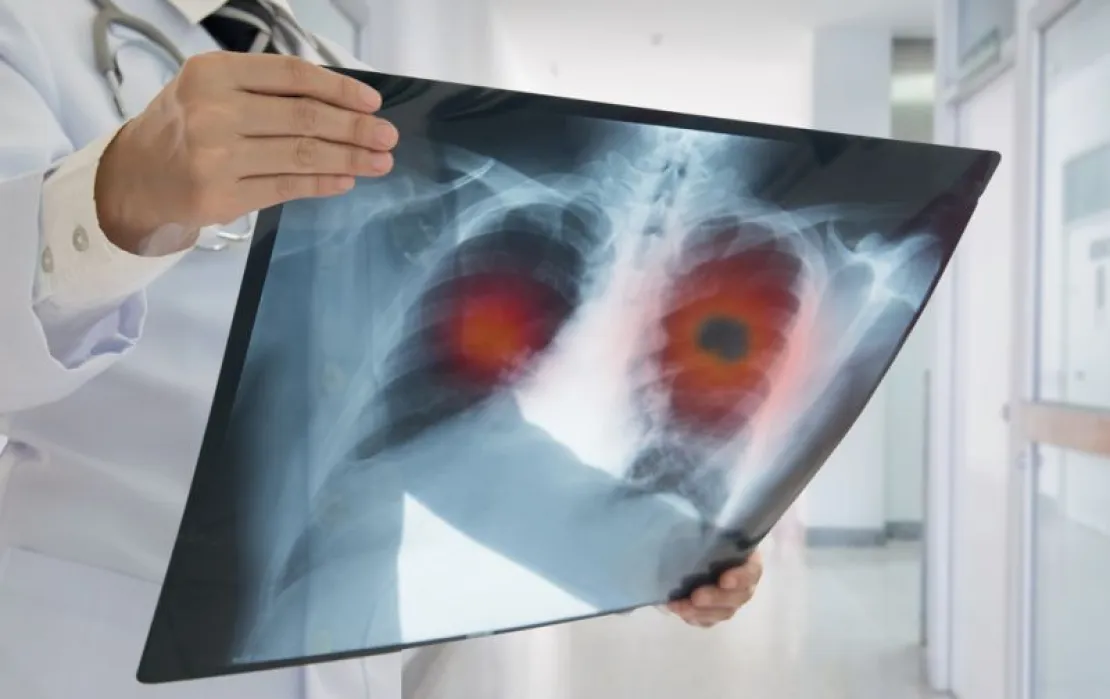 Sama- Sama Menyerang Paru, Tapi Apa Perbedaan Pneumonia dan Bronkitis?