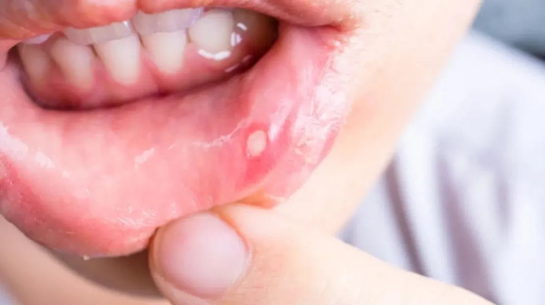 Kekurangan Vitamin C Jadi Penyebab Sariawan, Benarkah Hal Tersebut?