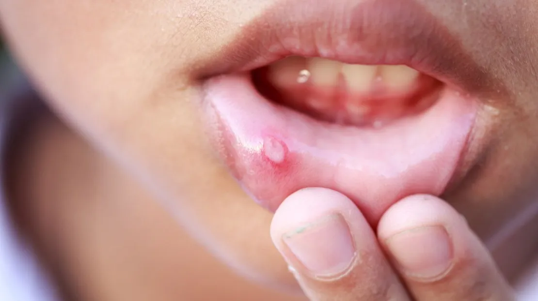 Rutin Minum Vitamin C, Cara Menghilangkan Sariawan yang Ampuh!
