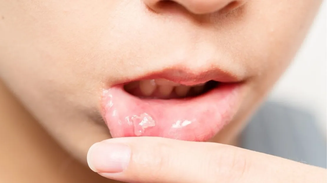 Sering Alami Sariawan Tanda Kurang Vitamin C, Benarkah Hal Tersebut?