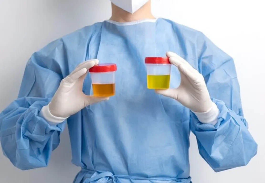5 Penyebab Kenapa Urine Berwarna Kuning, Apakah Normal?