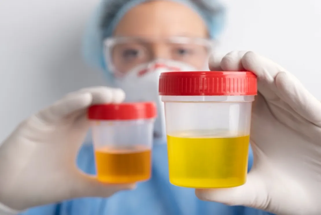 Urine Berwarna Kuning Setelah Minum Suplemen, Apakah Normal?