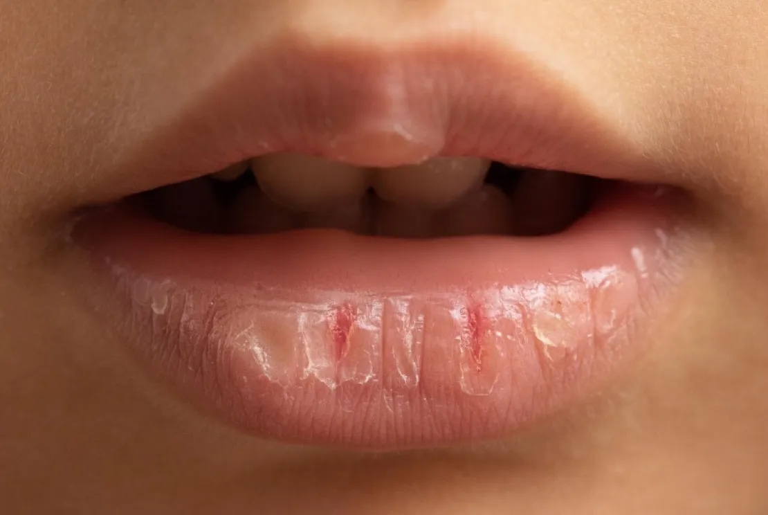 Cara Mengatasi Bibir Kering: Kenali Tanda Awal dan Solusi Tepat untuk Anda!