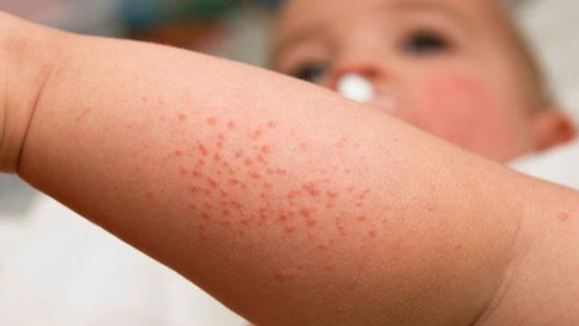 3 Ciri Kulit Sensitif Pada Bayi Yang Perlu Diperhatikan