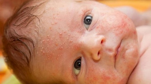 3 Ciri Kulit Sensitif Pada Bayi Yang Perlu Diperhatikan