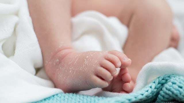 3 Ciri Kulit Sensitif Pada Bayi Yang Perlu Diperhatikan