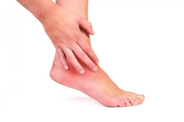 4 Cara Mengatasi Kaki Melepuh Setelah Memakai Sepatu