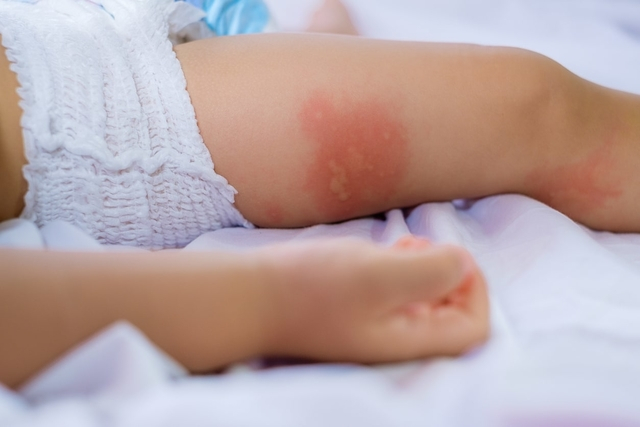 5 Cara Mengatasi Ruam Popok Pada Bayi
