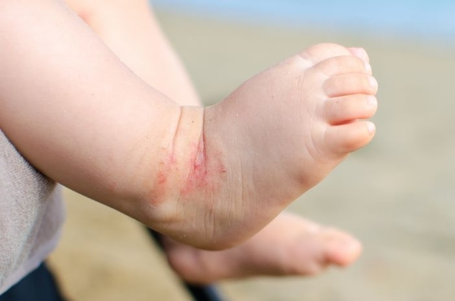 Manfaat Petroleum Jelly Untuk Kulit Bayi