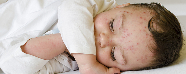 3 Langkah Yang Harus Dilakukan Orangtua Ketika Anak Alergi Susu Sapi