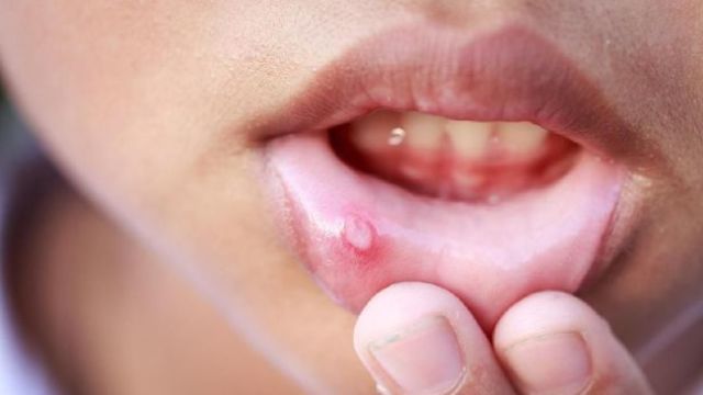 Sariawan Sulit Sembuh? Ini Tanda Kekurangan Vitamin C!
