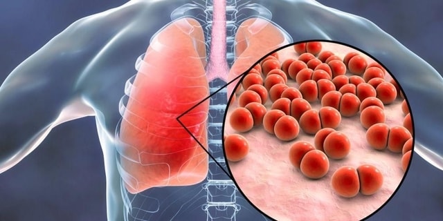 Sama- Sama Menyerang Paru, Tapi Apa Perbedaan Pneumonia dan Bronkitis?