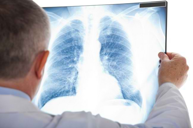 Nyaris Mirip! Ini Lho Bedanya Pneumonia dan Covid-19