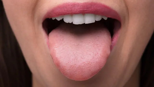 Covid Tounge: Gejala Corona yang Mirip Sariawan