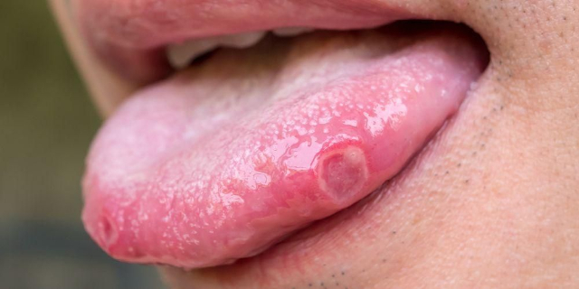 Covid Tounge: Gejala Corona yang Mirip Sariawan