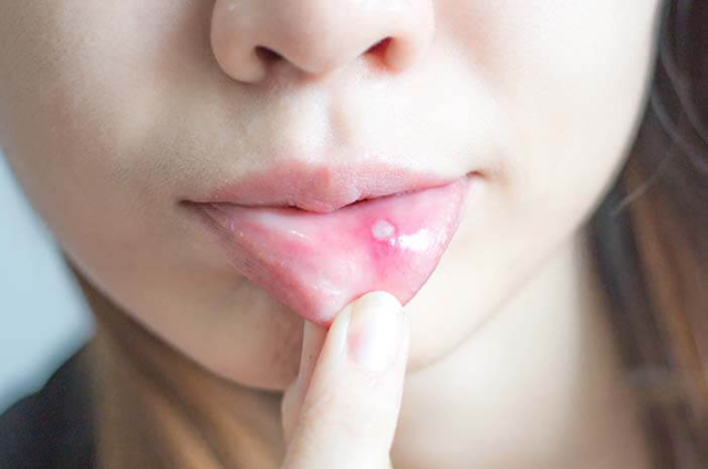 Kekurangan Vitamin C Jadi Penyebab Sariawan, Benarkah Hal Tersebut?