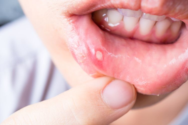 Kekurangan Vitamin C Jadi Penyebab Sariawan, Benarkah Hal Tersebut?