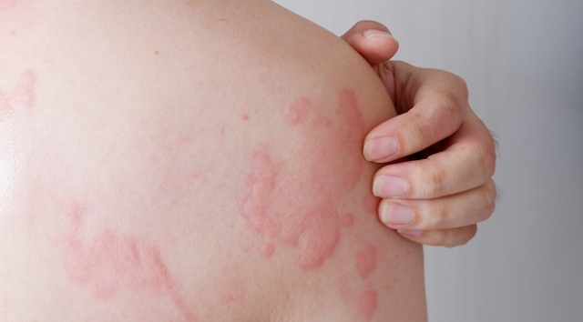 4 Alasan Mengapa Tubuh Bisa Alami Alergi Dingin, Termasuk Reaksi Sistem Imun?