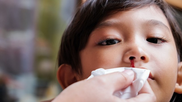 Kenali Penyebab Mimisan pada Anak dan Tips Mengatasinya