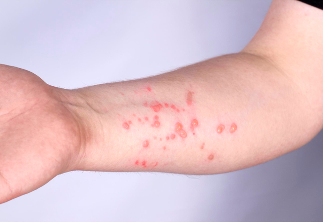 Mengenal Apa Itu Monkeypox, Gejala & Pengobatannya Berikut!